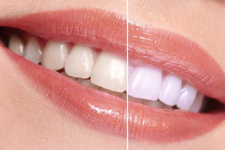 ۱۰روش سفید کردن طبیعی دندان