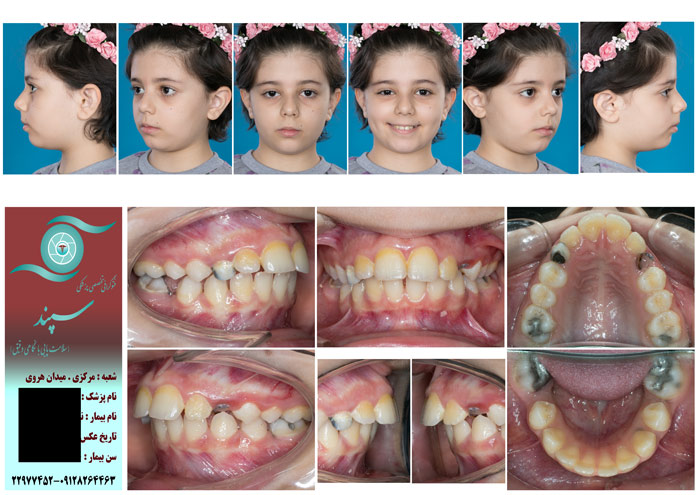 فتوگرافی ارتودنسی (عکس فتوگرافی دندان) از کودکان